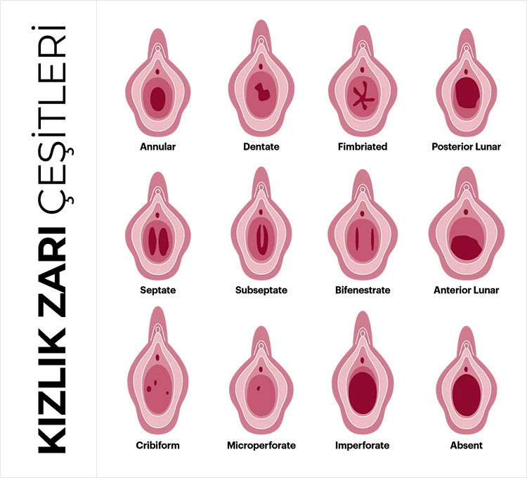 Kızlık Zarı (Hymen) Çeşitleri