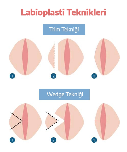 Labioplasti Teknikleri